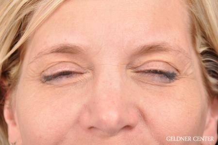 Eyelid Lift: Patient 9 - After 3
