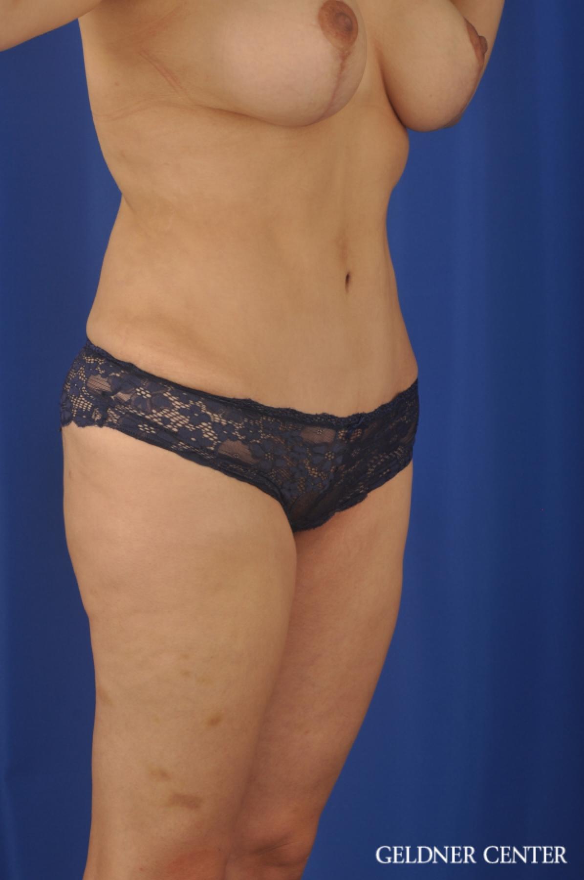 Tummy Tuck: Patient 24 - After 2