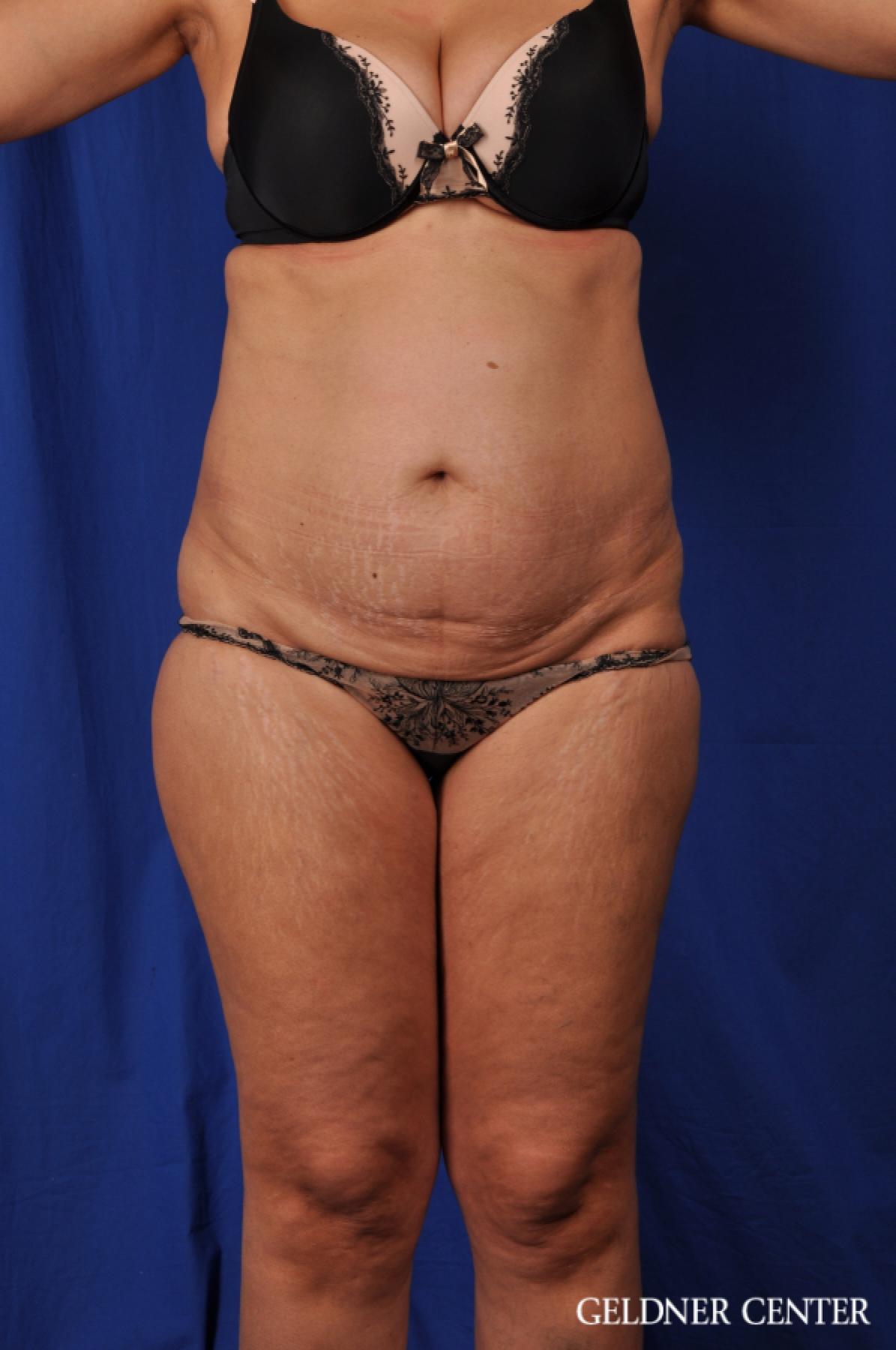 Tummy Tuck: Patient 21 - Before 