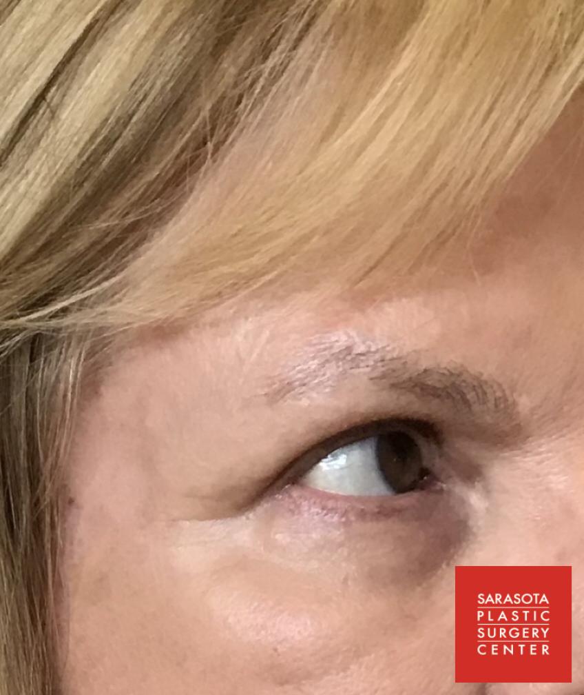 Permanent Makeup - Eyebrows: Patient 25 - Before 