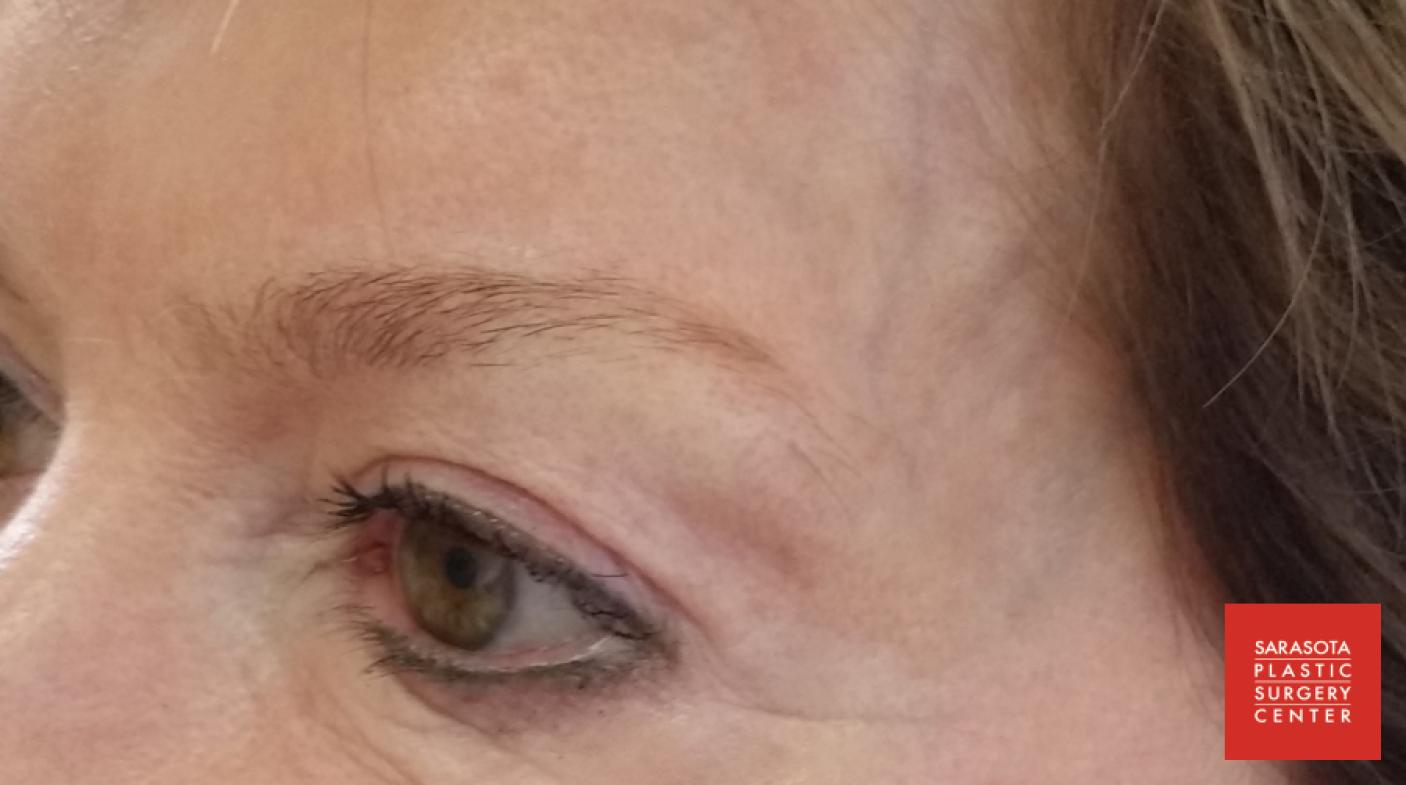 Permanent Makeup - Eyebrows: Patient 13 - Before 