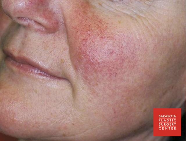 Intense Pulsed Light (IPL): Patient 4 - Before 