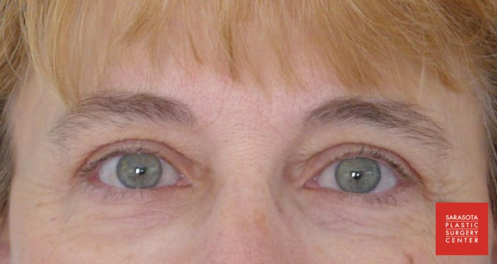 Permanent Makeup - Eyeliner: Patient 2 - After  
