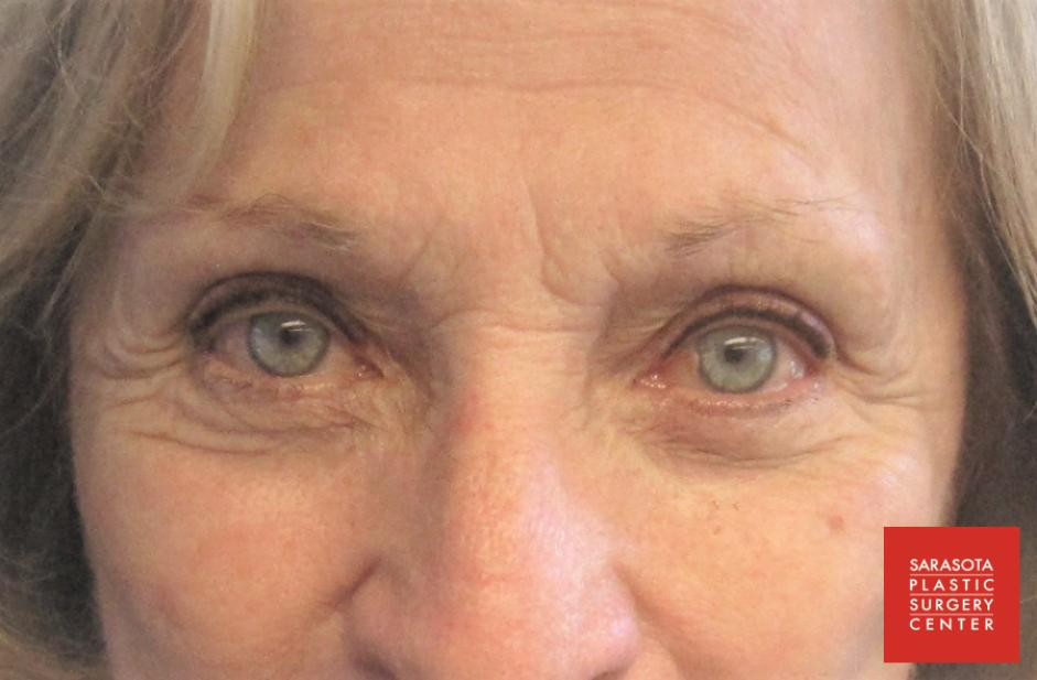 Permanent Makeup - Eyeliner: Patient 4 - Before and After  