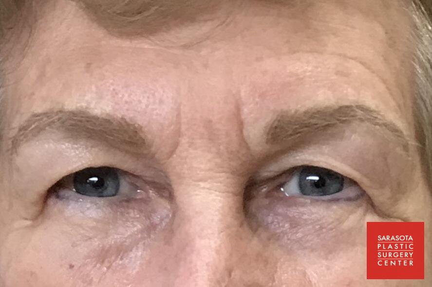 Permanent Makeup - Eyebrows: Patient 20 - After 