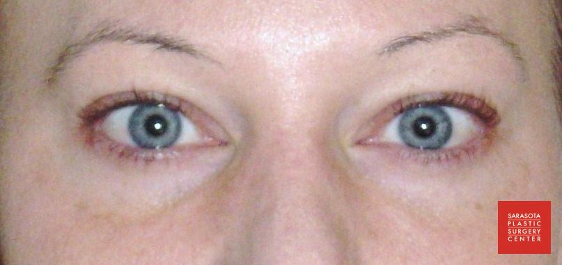 Permanent Makeup - Eyeliner: Patient 1 - After  