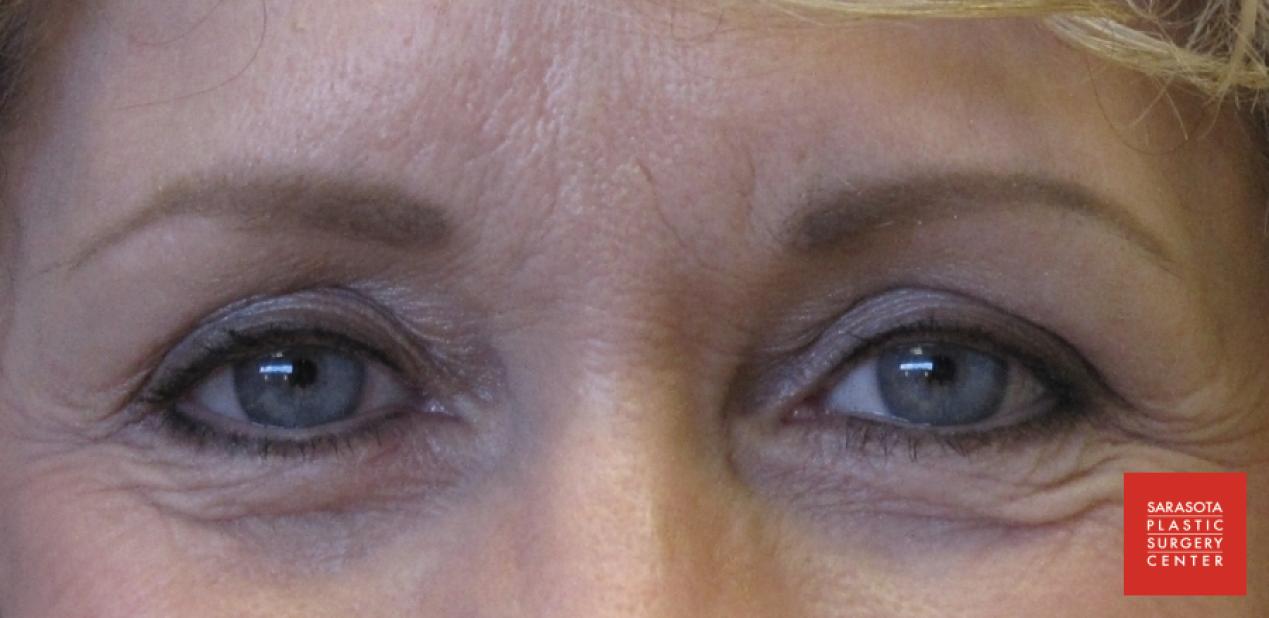 Permanent Makeup - Eyebrows: Patient 1 - After  