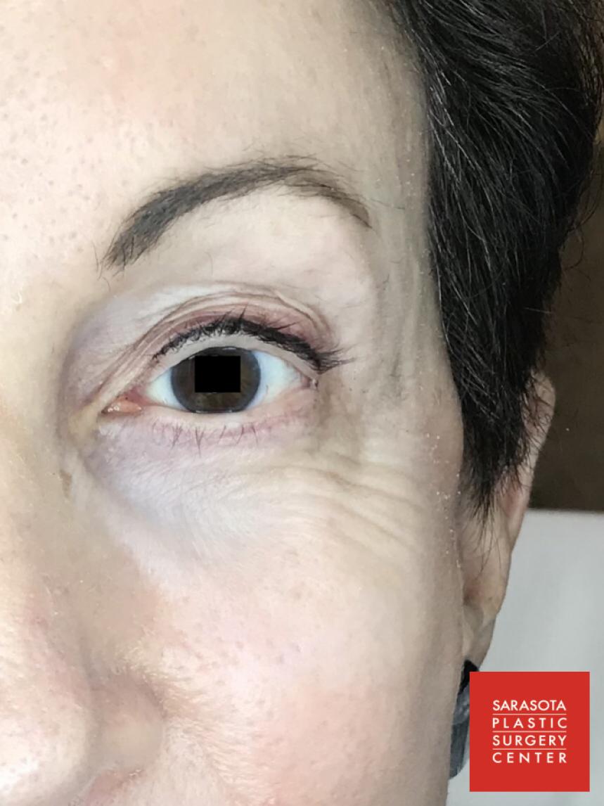 Permanent Makeup - Eyeliner: Patient 6 - After  