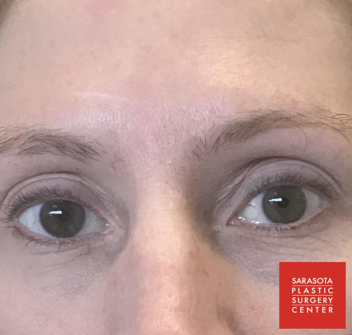 Permanent Makeup - Eyeliner: Patient 8 - After  