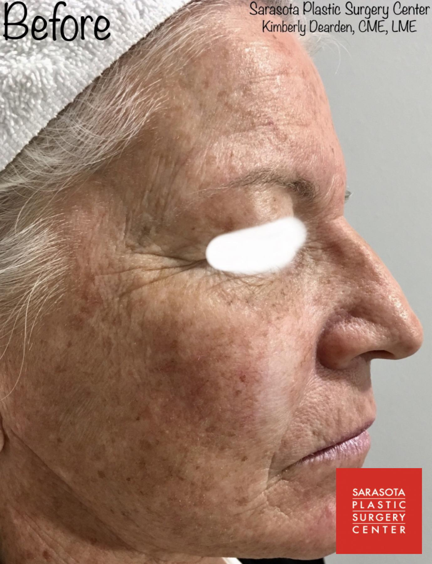 Intense Pulsed Light (IPL): Patient 1 - Before 