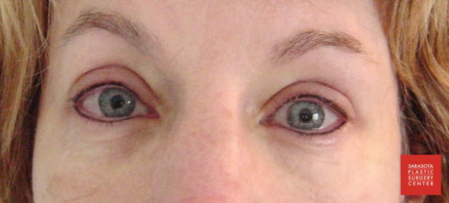 Permanent Makeup - Eyeliner: Patient 5 - After  