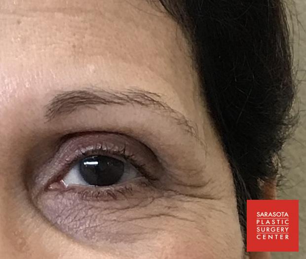 Permanent Makeup - Eyebrows: Patient 23 - Before 