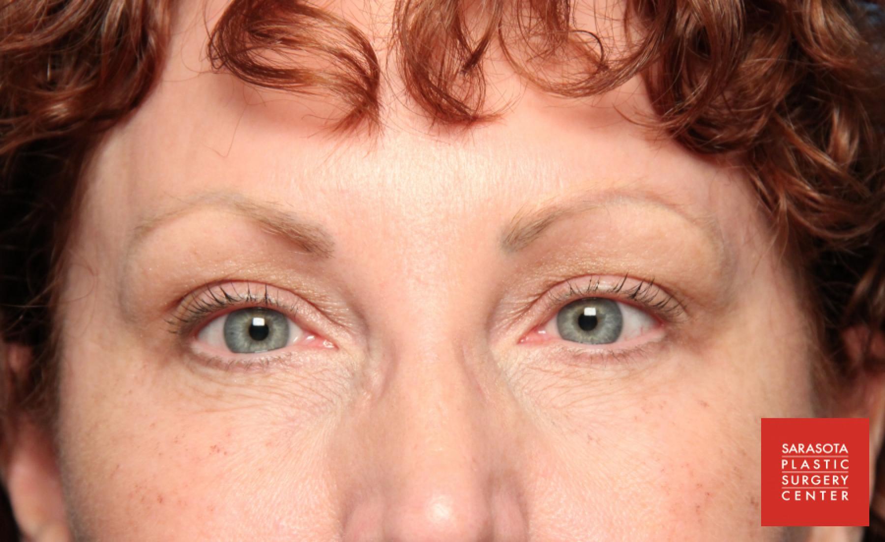 Permanent Makeup - Eyebrows: Patient 11 - Before 