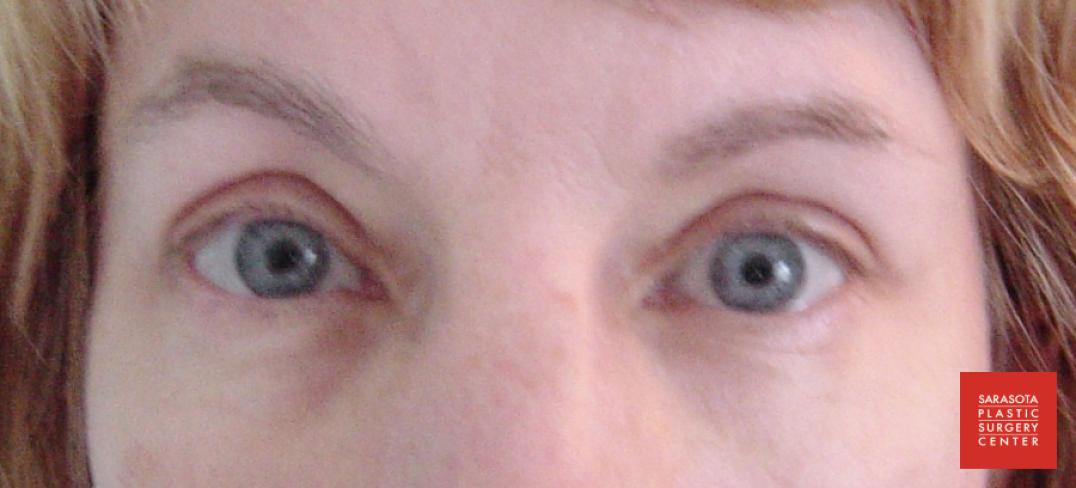 Permanent Makeup - Eyeliner: Patient 5 - After  