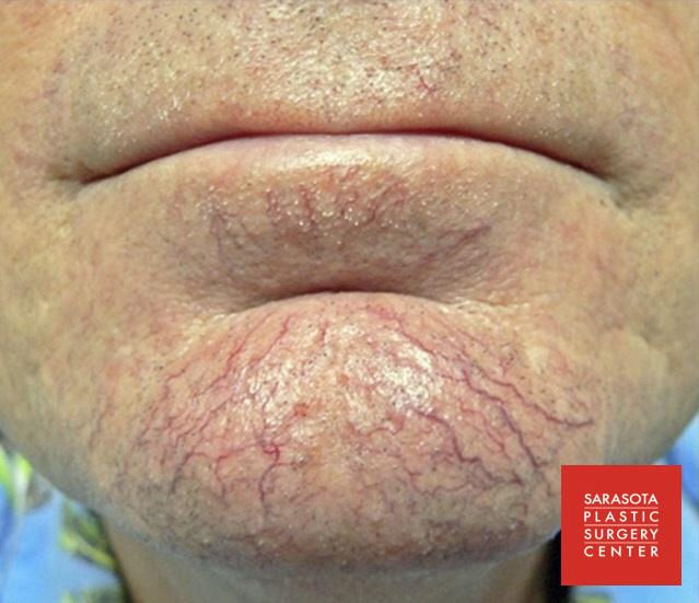 Intense Pulsed Light (IPL): Patient 2 - Before 