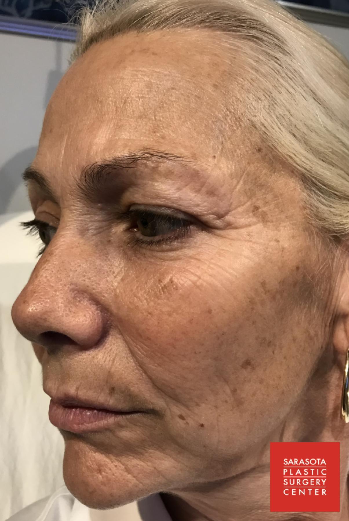 Intense Pulsed Light (IPL): Patient 5 - Before 