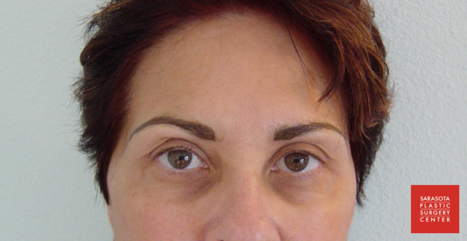 Permanent Makeup - Eyebrows: Patient 5 - After  