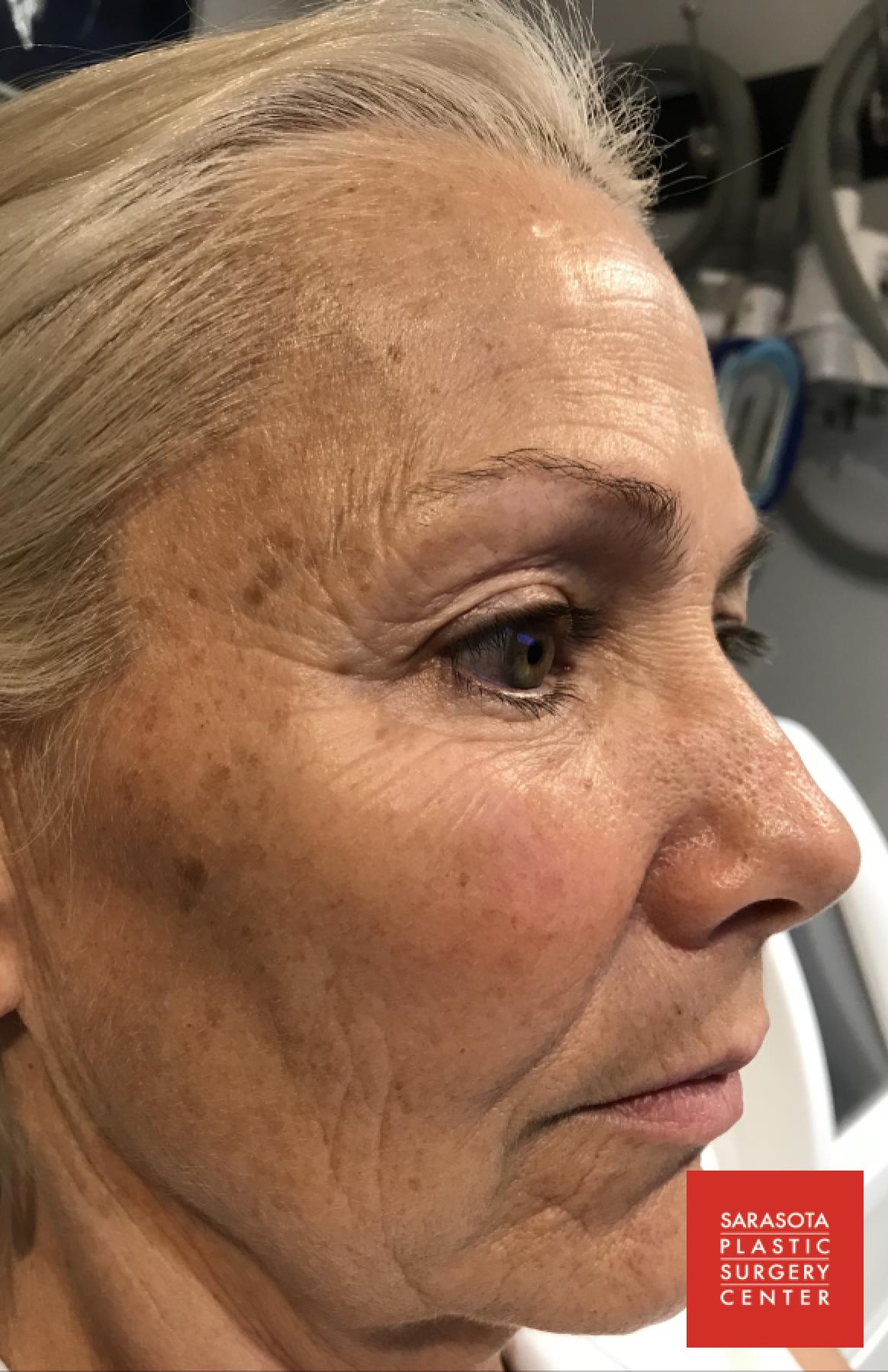 Intense Pulsed Light (IPL): Patient 5 - Before and After 2