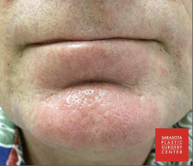 Intense Pulsed Light (IPL): Patient 2 - After  