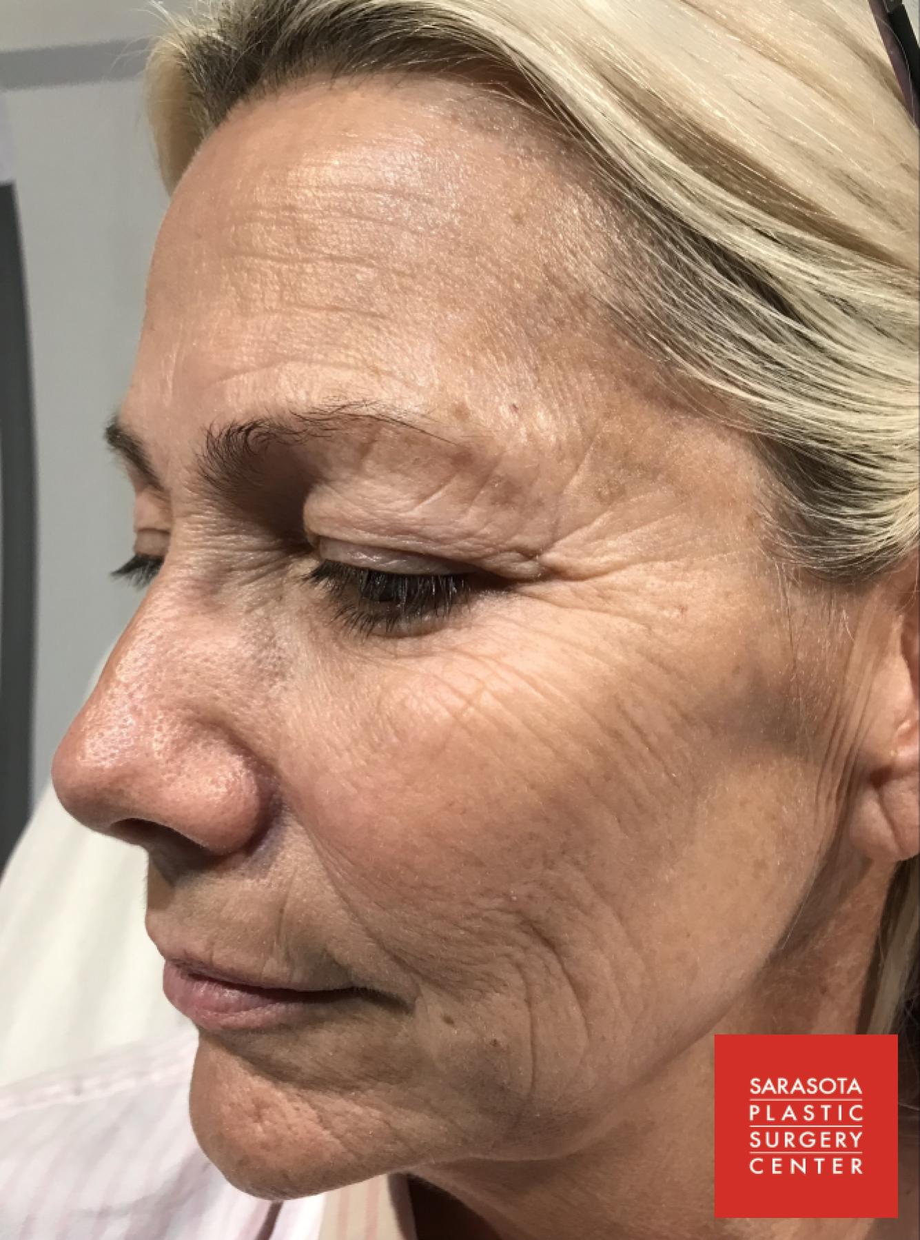 Intense Pulsed Light (IPL): Patient 5 - After  