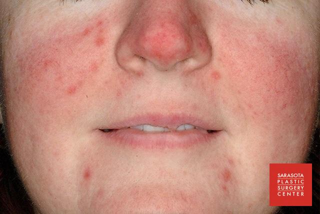 Intense Pulsed Light (IPL): Patient 3 - Before 