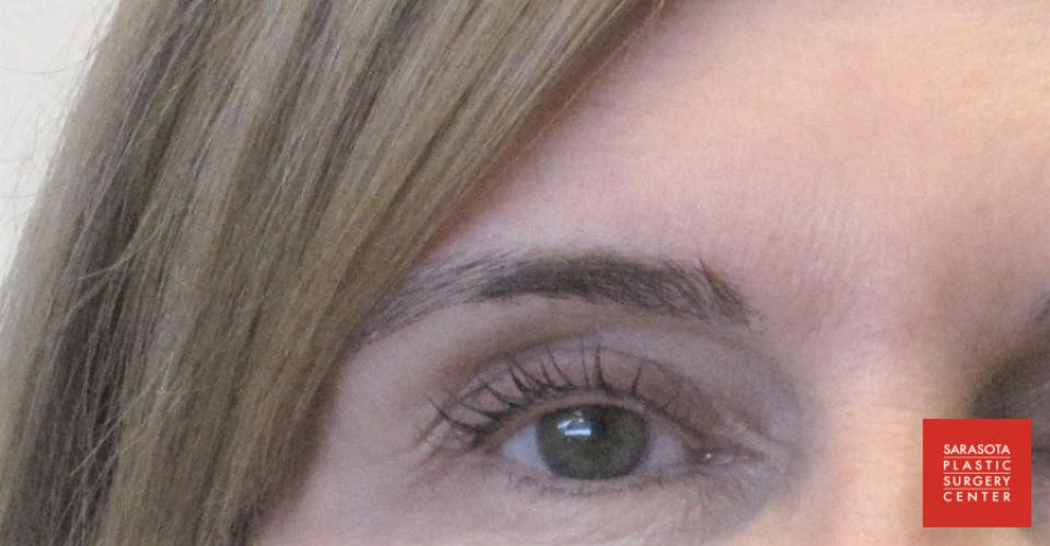 Permanent Makeup - Eyeliner: Patient 3 - Before and After  