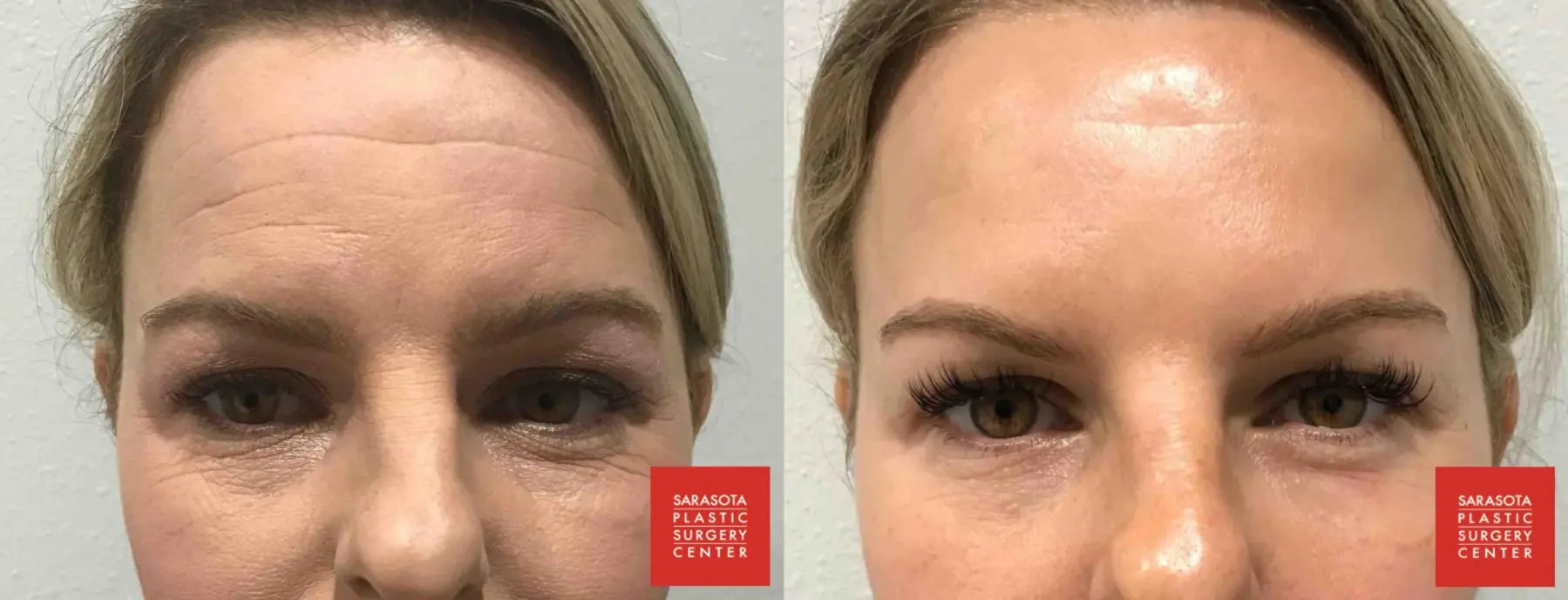 BOTOX® Cosmetic: Patient 1 - Before and After  