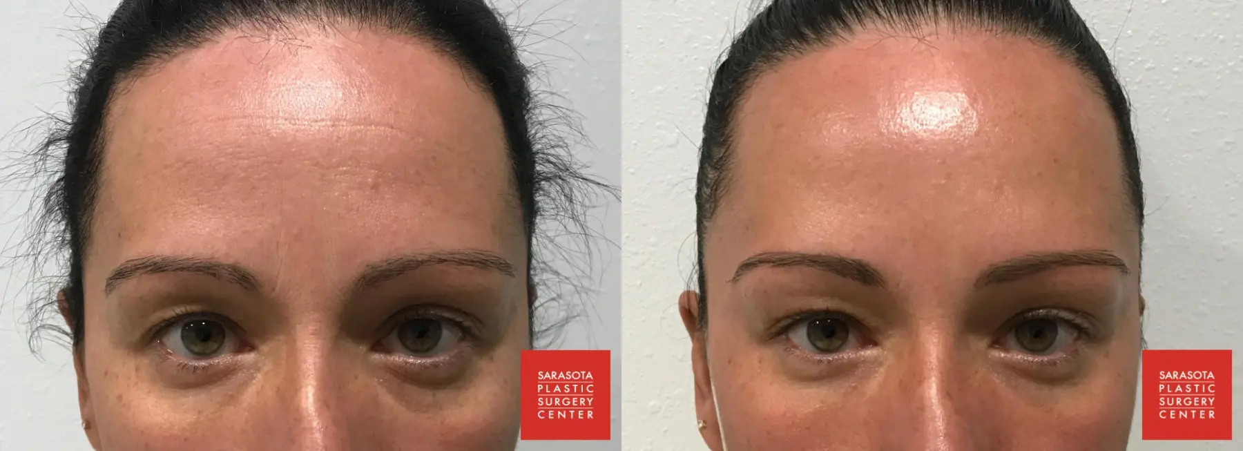 BOTOX® Cosmetic: Patient 4 - Before and After  