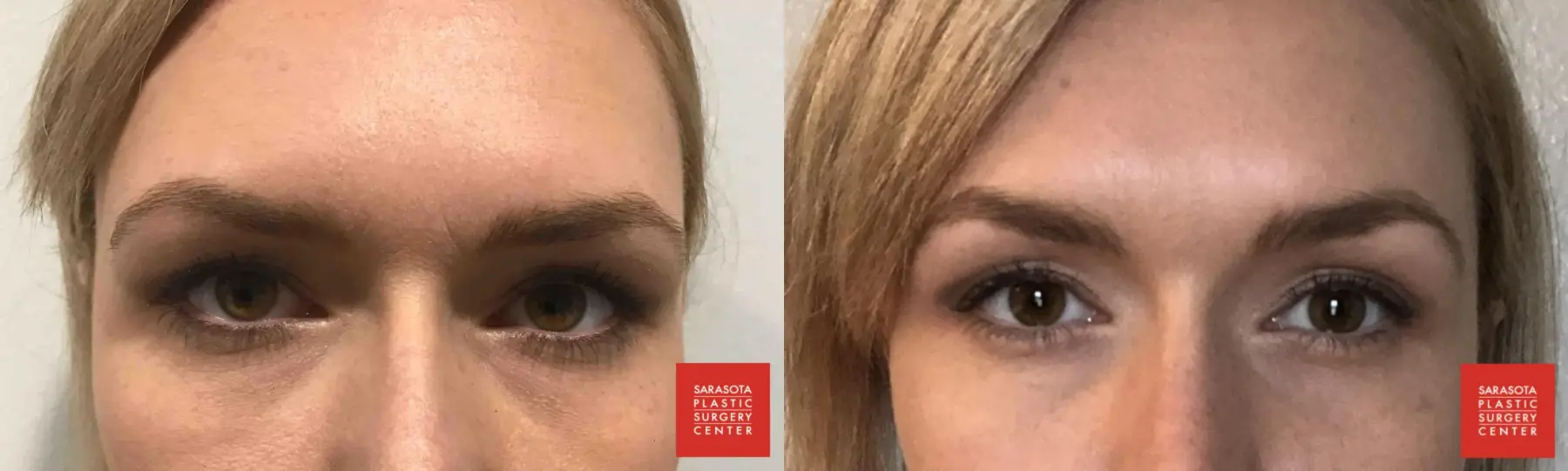 BOTOX® Cosmetic: Patient 2 - Before and After  