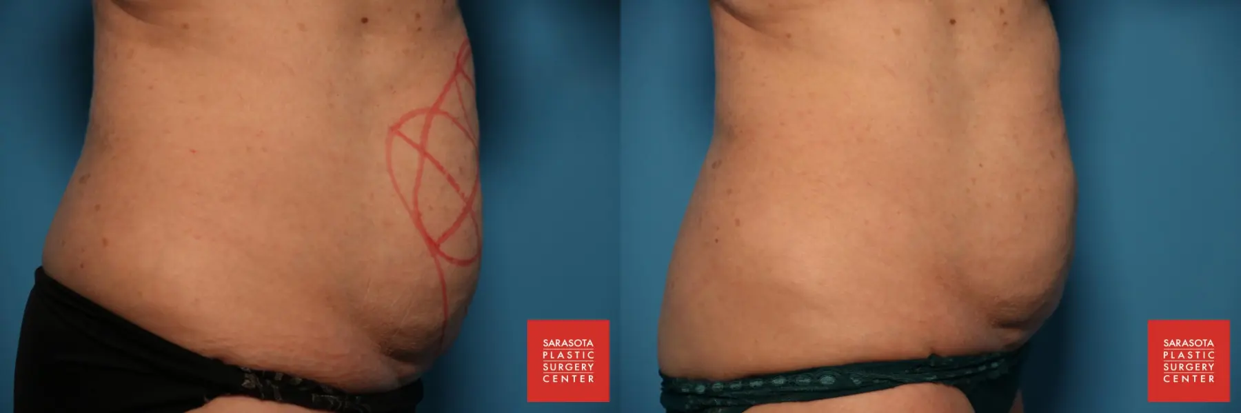CoolSculpting®: Patient 7 - Before and After 4