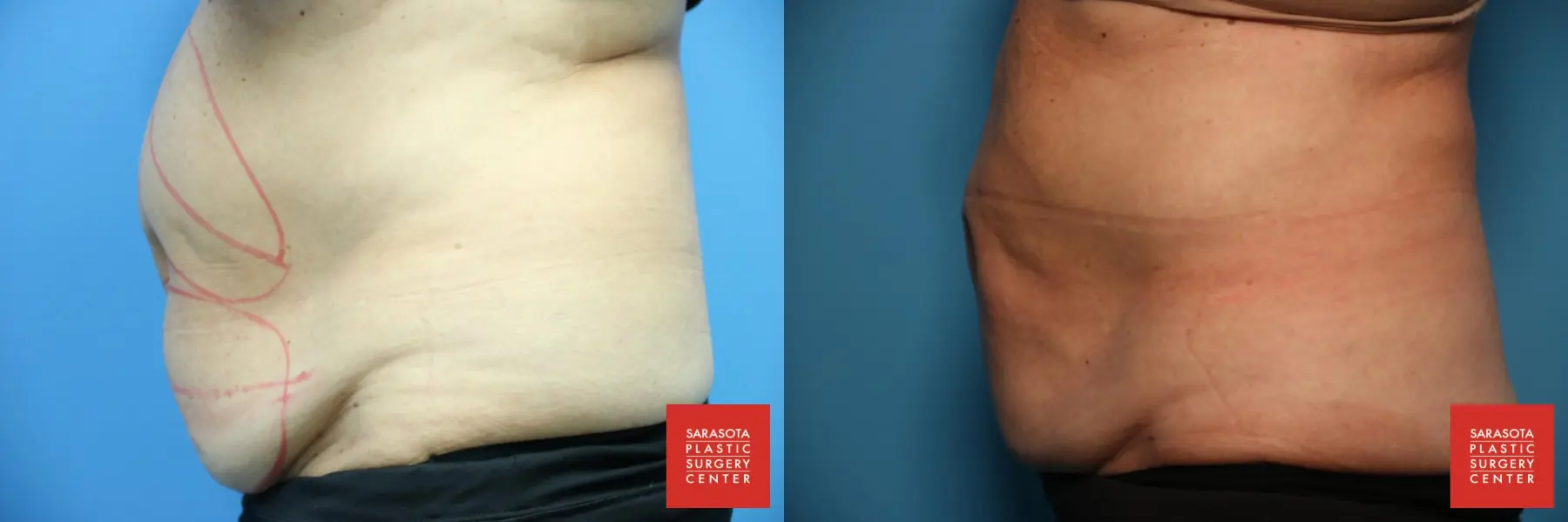 CoolSculpting®: Patient 6 - Before and After 3