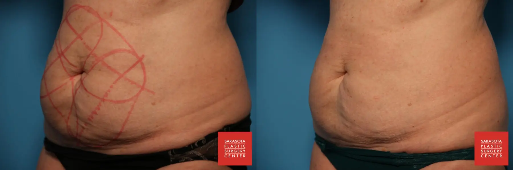 CoolSculpting®: Patient 7 - Before and After 2