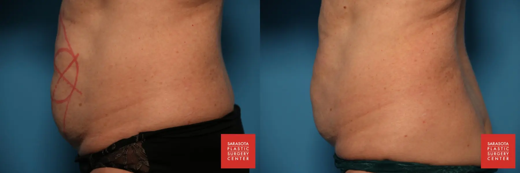CoolSculpting®: Patient 7 - Before and After 3
