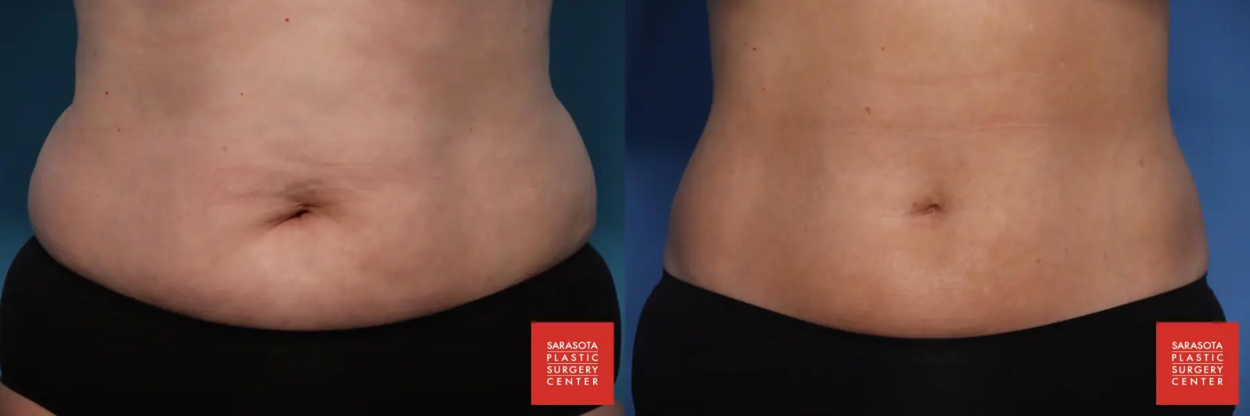 CoolSculpting®: Patient 4 - Before and After  