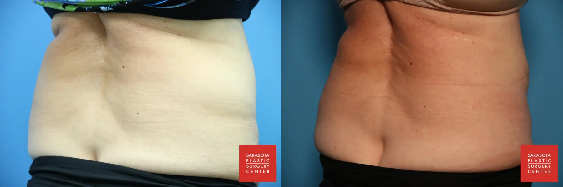 CoolSculpting®: Patient 6 - Before and After 6