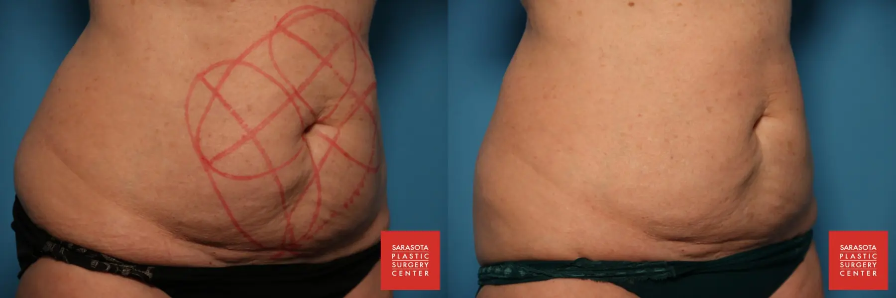 CoolSculpting®: Patient 7 - Before and After 5