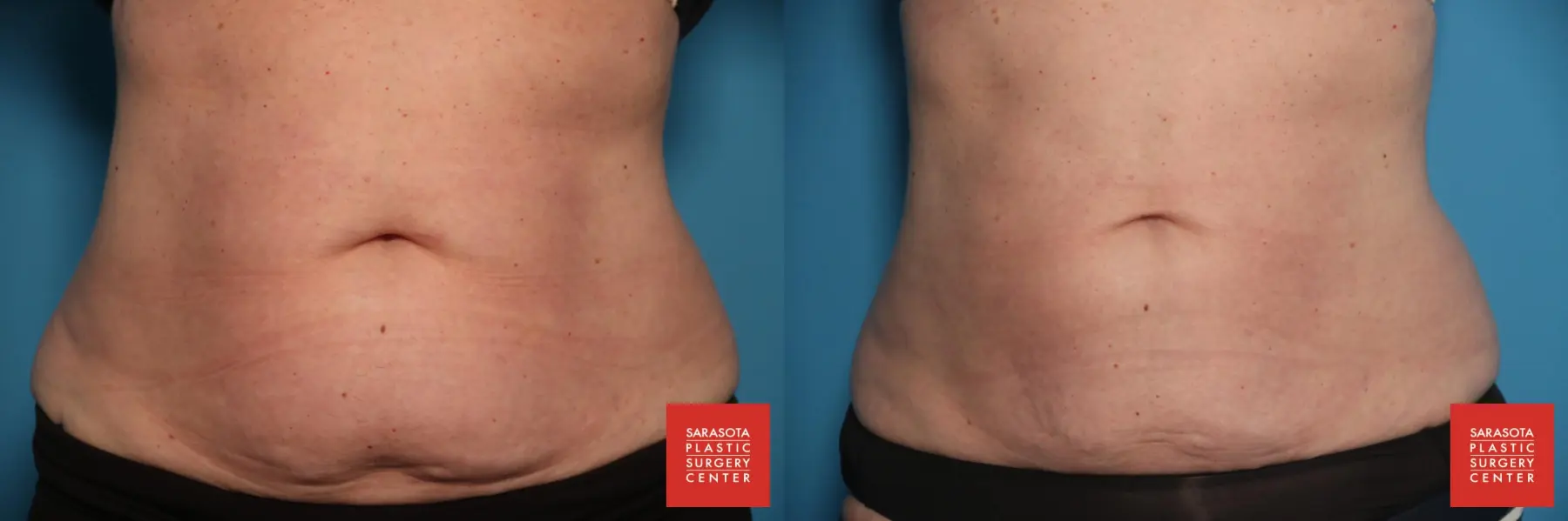 CoolSculpting®: Patient 3 - Before and After  