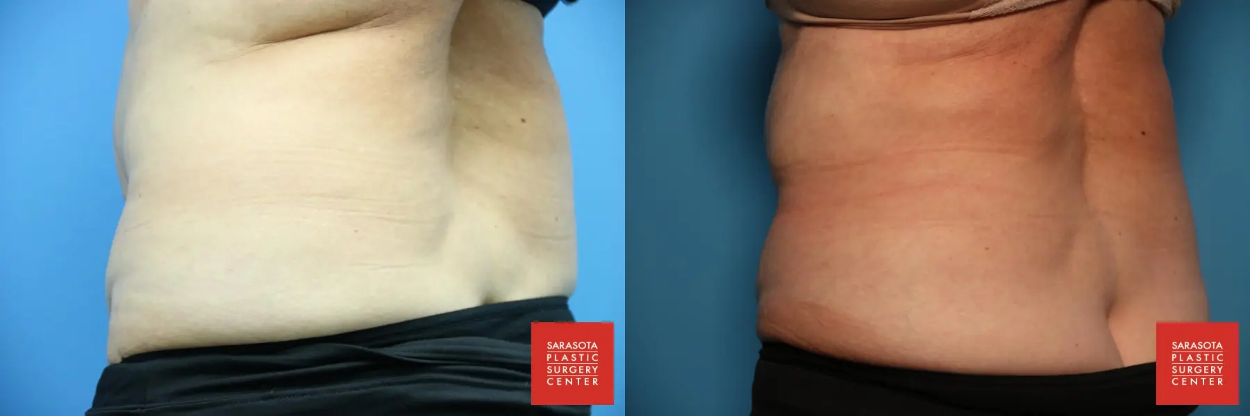 CoolSculpting®: Patient 6 - Before and After 4
