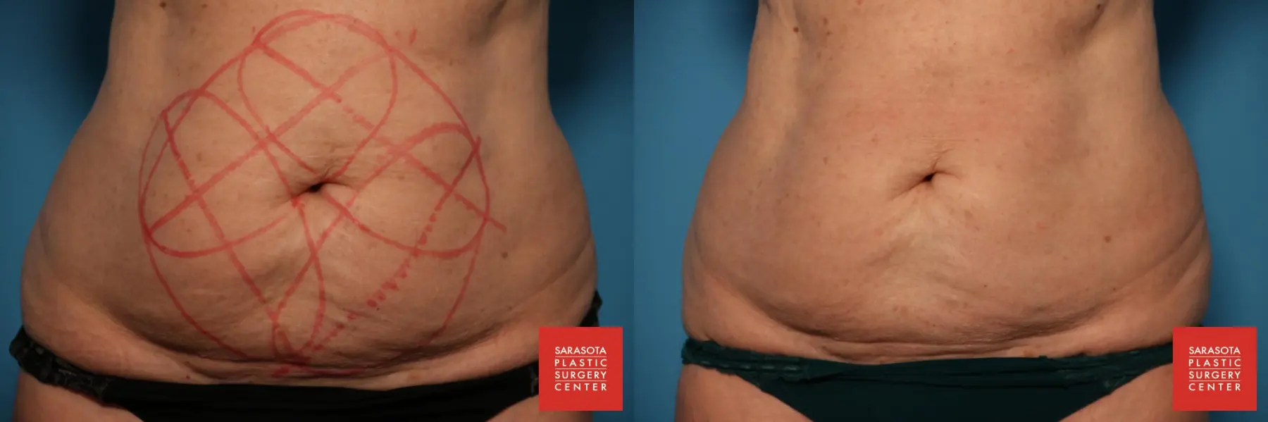CoolSculpting®: Patient 7 - Before and After  