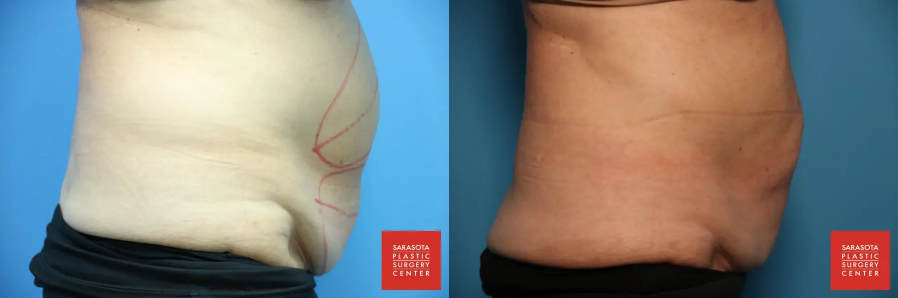 CoolSculpting®: Patient 6 - Before and After 7