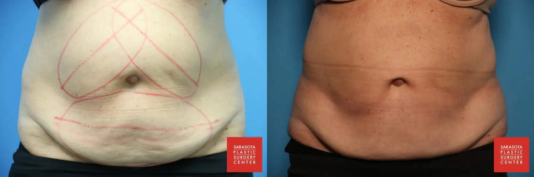 CoolSculpting®: Patient 6 - Before and After  