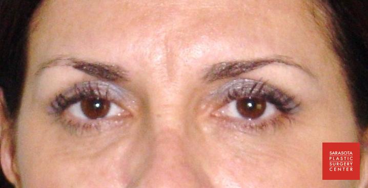 Permanent Makeup - Eyebrows: Patient 9 - After  