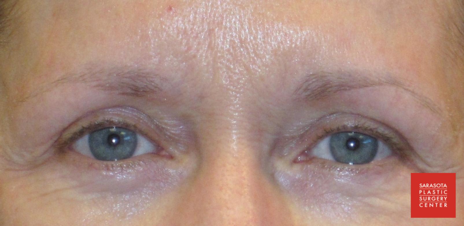 Permanent Makeup - Eyebrows: Patient 1 - After  