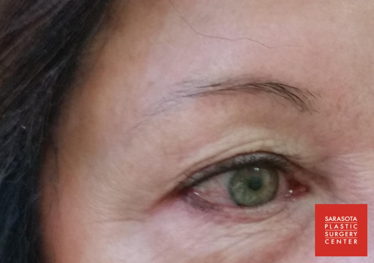 Permanent Makeup - Eyebrows: Patient 16 - Before 