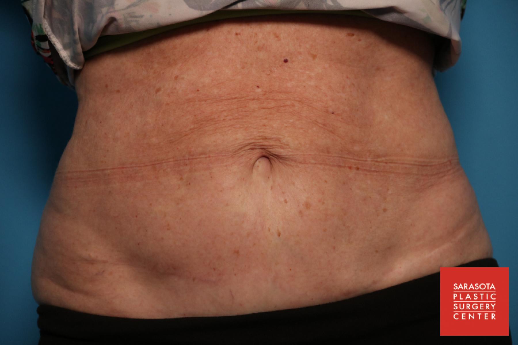 CoolSculpting®: Patient 1 - After  