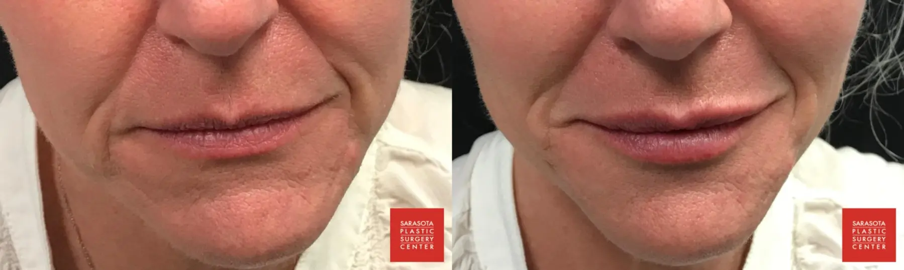 Injectables - Face: Patient 4 - Before and After  