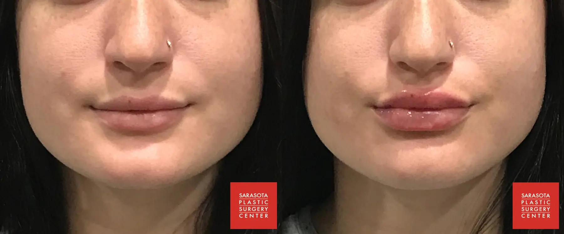 Injectables - Face: Patient 2 - Before and After  