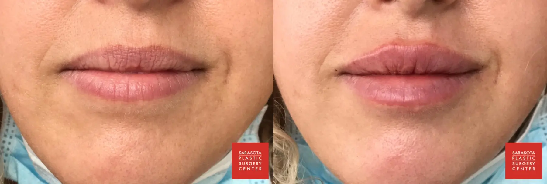 Injectables - Face: Patient 5 - Before and After  