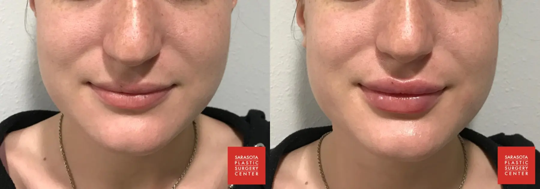 Injectables - Face: Patient 3 - Before and After  