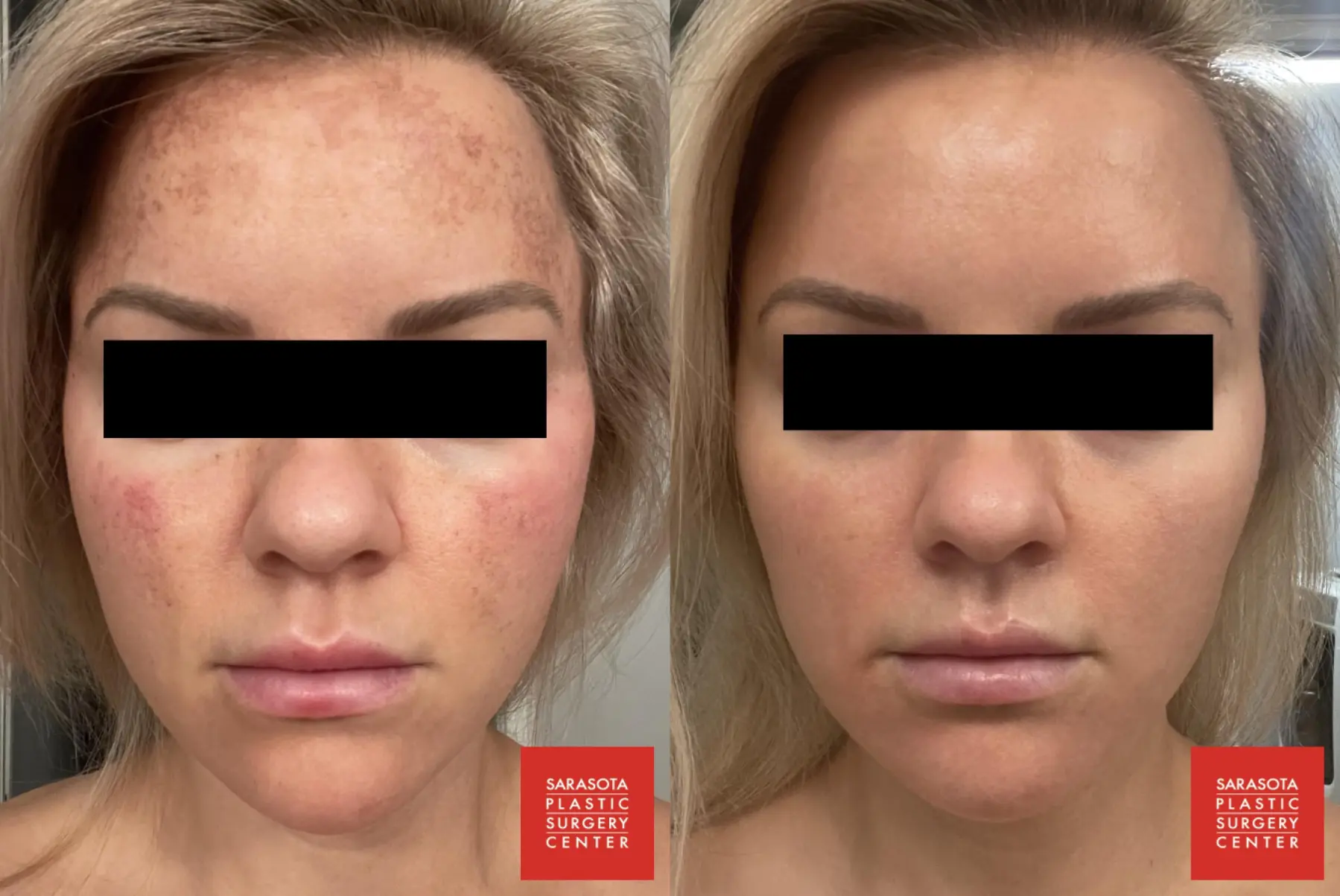 Intense Pulsed Light (IPL): Patient 6 - Before and After  